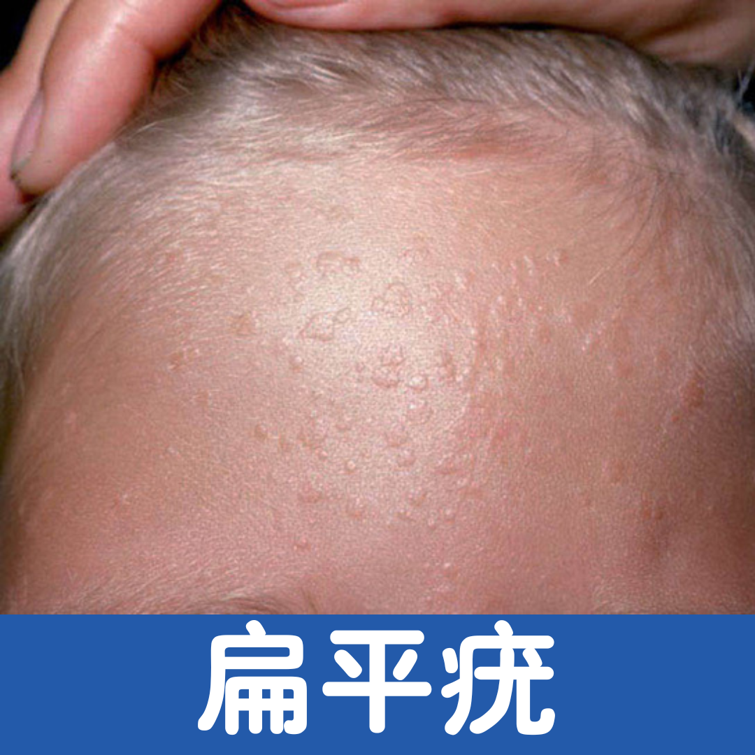 最新祛疣资讯，治疗方法和成功案例分享